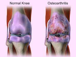 osteoarthritis lutut